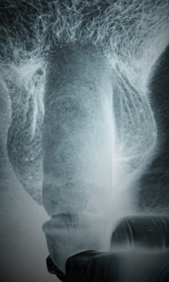 Stylized X-ray-style medical photograph four weeks after penile augmentation with a total of 20 cc of Juvéderm Voluma